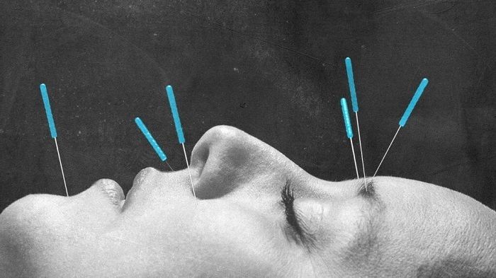 Is Acupuncture More Effective Than Painkillers for Managing Migraine Attacks.jpg