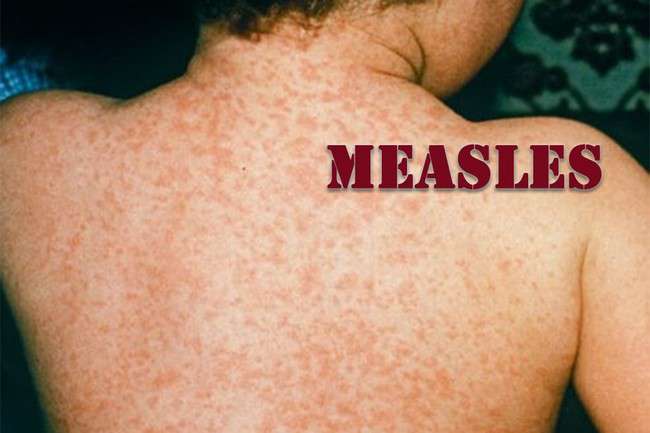 measles 3.jpg