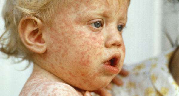 measles_wide.jpg