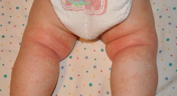 My-Baby’s-Heat-Rash.jpg